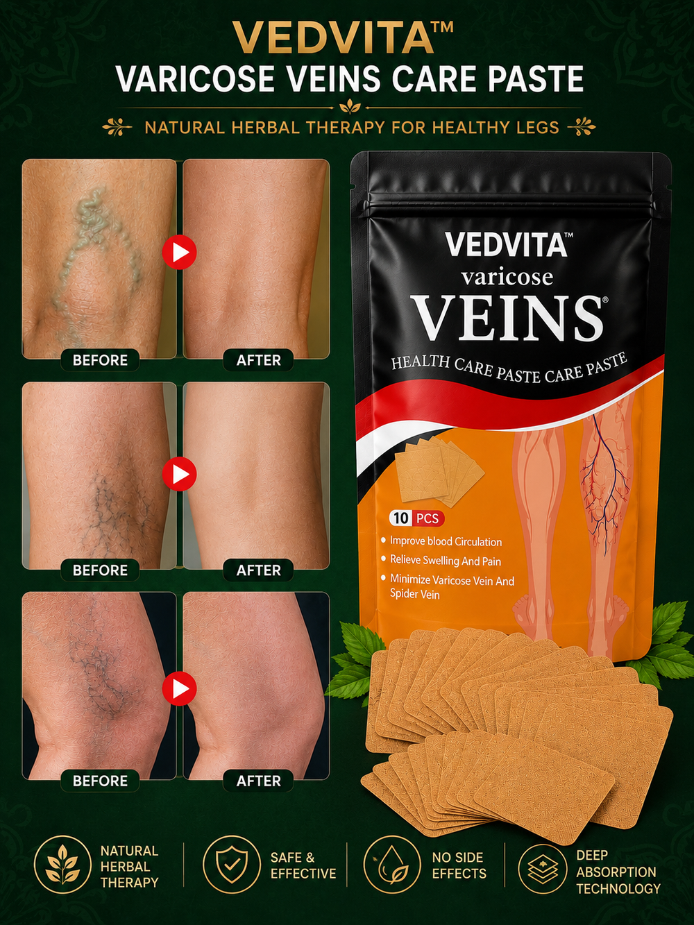 Vedvita™ Spider & Varicose Vein Patches | Natural Herbal Therapy for Swelling, Fatigue & Vein Health